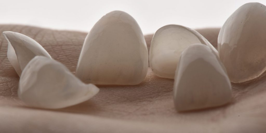 Faccette dentali