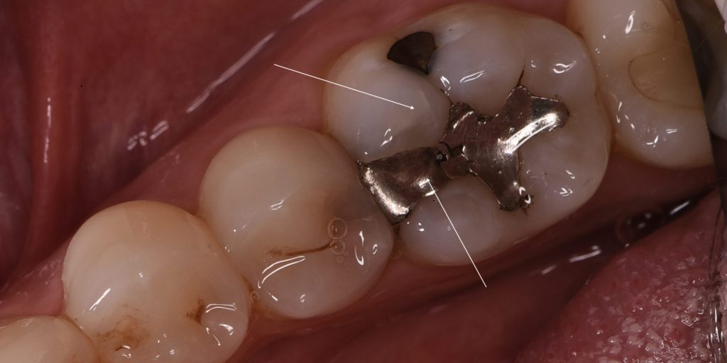 otturazioni dentali