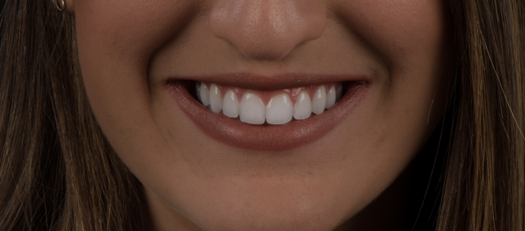 sbiancamento dentale